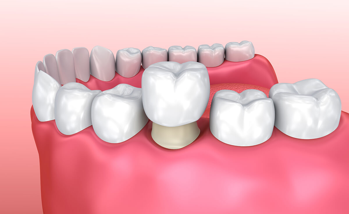 Dental Crown Care Essentials You Need to Know