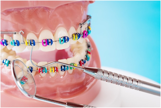 Fixed Dental Orthodontics Pros and Cons