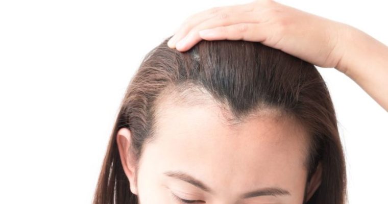 Herbal Treatment for Dandruff and Hair Loss