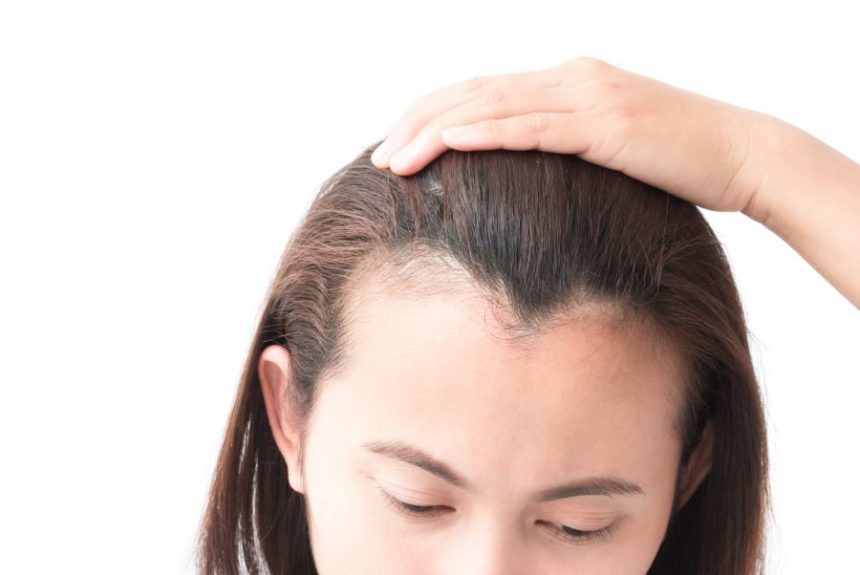 Herbal Treatment for Dandruff and Hair Loss