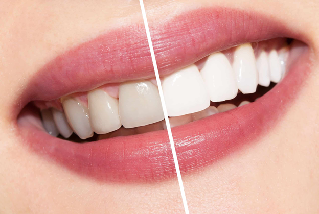 Teeth whitening: Procedures & Effectiveness