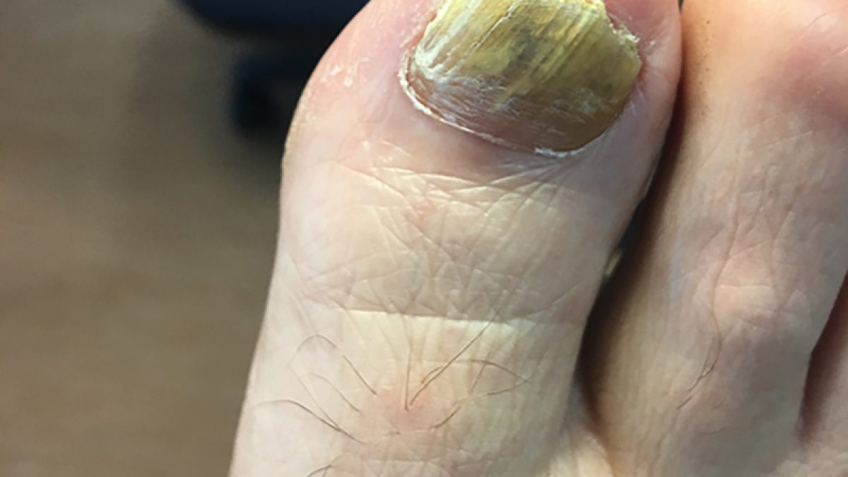 Why do we develop fungal nail infections?