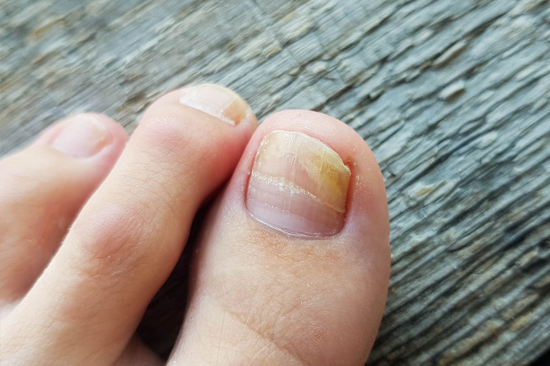 toenail fungus pictures before and after