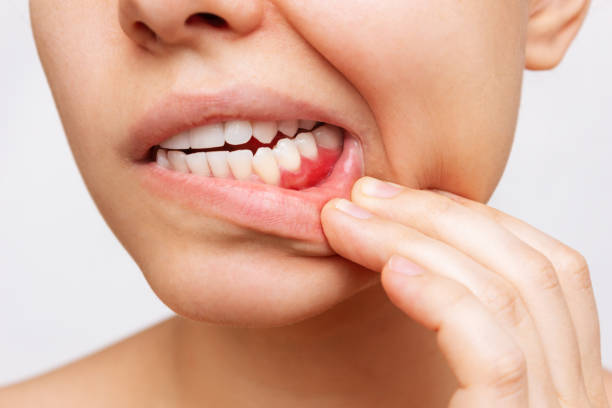 The Connection Between Bleeding Gums and Heart Health